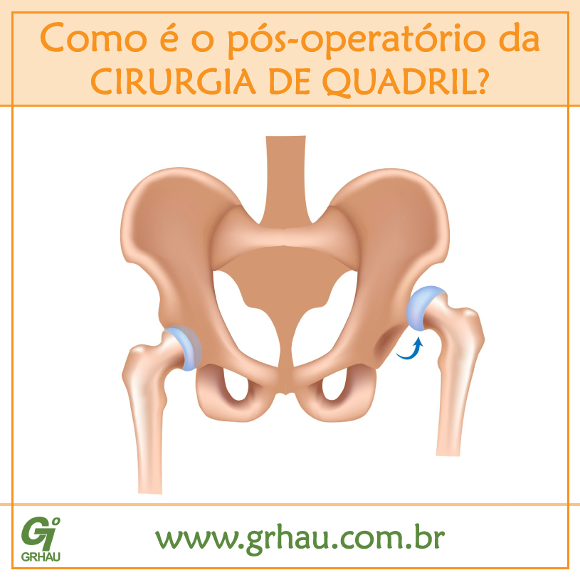 Como é o pósoperatório da cirurgia de quadril? GRHAU Therasuit Como é o pósoperatório da cirurgia de quadril? GRHAU Therasuit