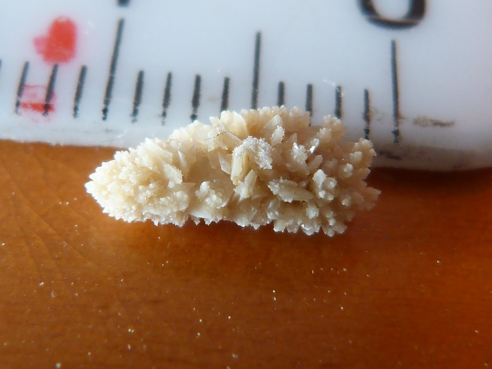 Mr. Eddy's Geology and Education Blog Kidney Stones Are They Rocks