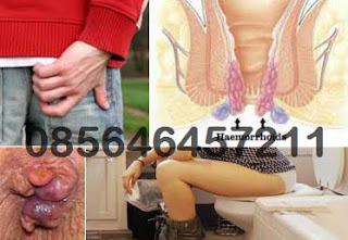 Apotik Online Yg Jual Obat Wasir AmbeJOSS Zaitop Apotik Online Yg Jual Obat Wasir AmbeJOSS Zaitop