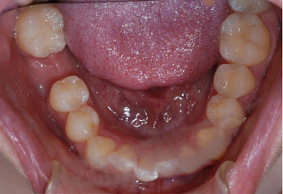 Có nên trồng răng cấm không? 