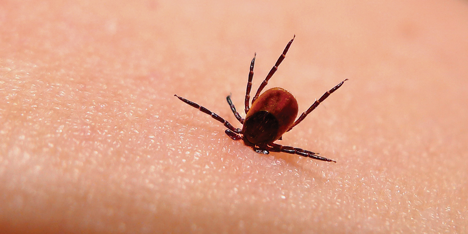 typhus fever