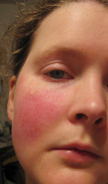 Causes of facial flushing and lidocaine Woman enjoying orgasm