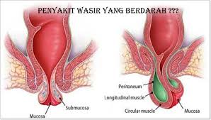 Foto obat ambein herbal alami