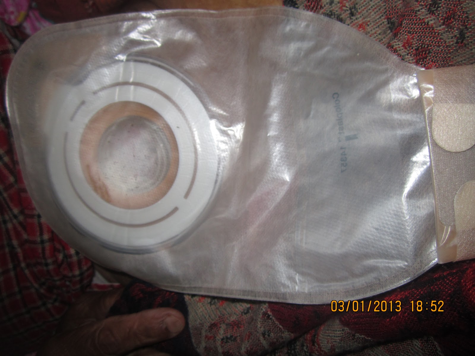 Stoma Care How to apply colostomy bag on uneven skin