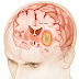 Tumeur cerveau symptomes et tumeur au cerveau traitement