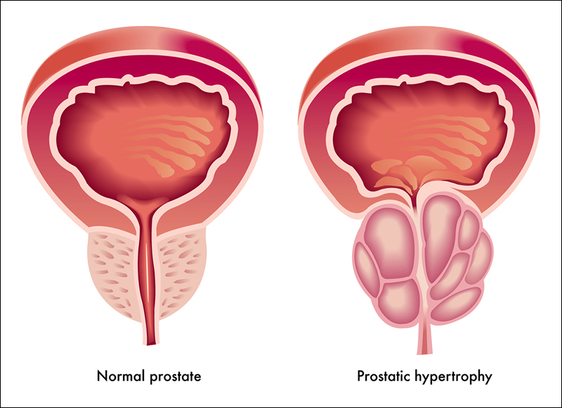 Benign prostatic hyperplasia, diet in prostate problem, prostate enlargement diet