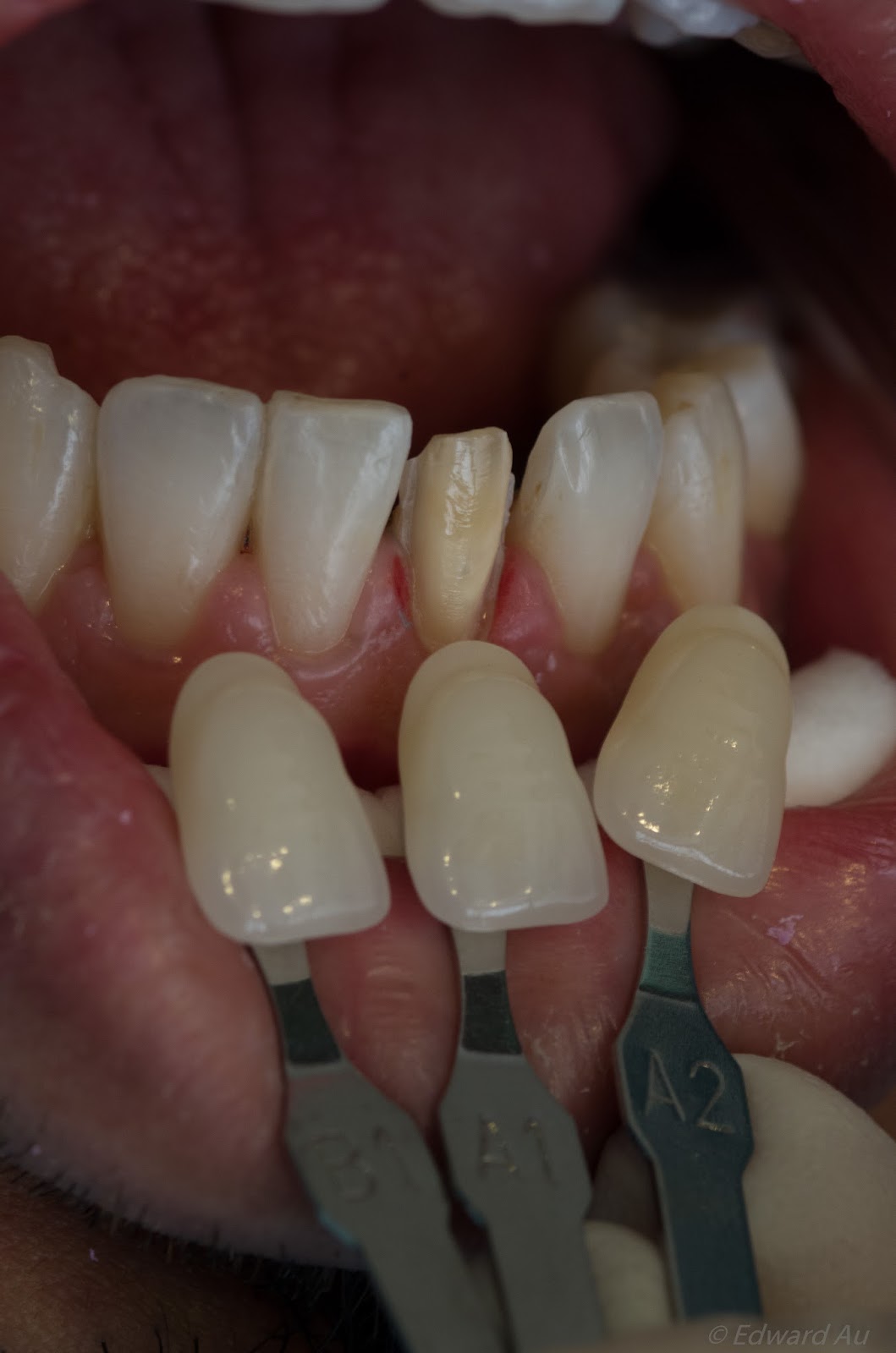 Malaysian Dentist Veneers