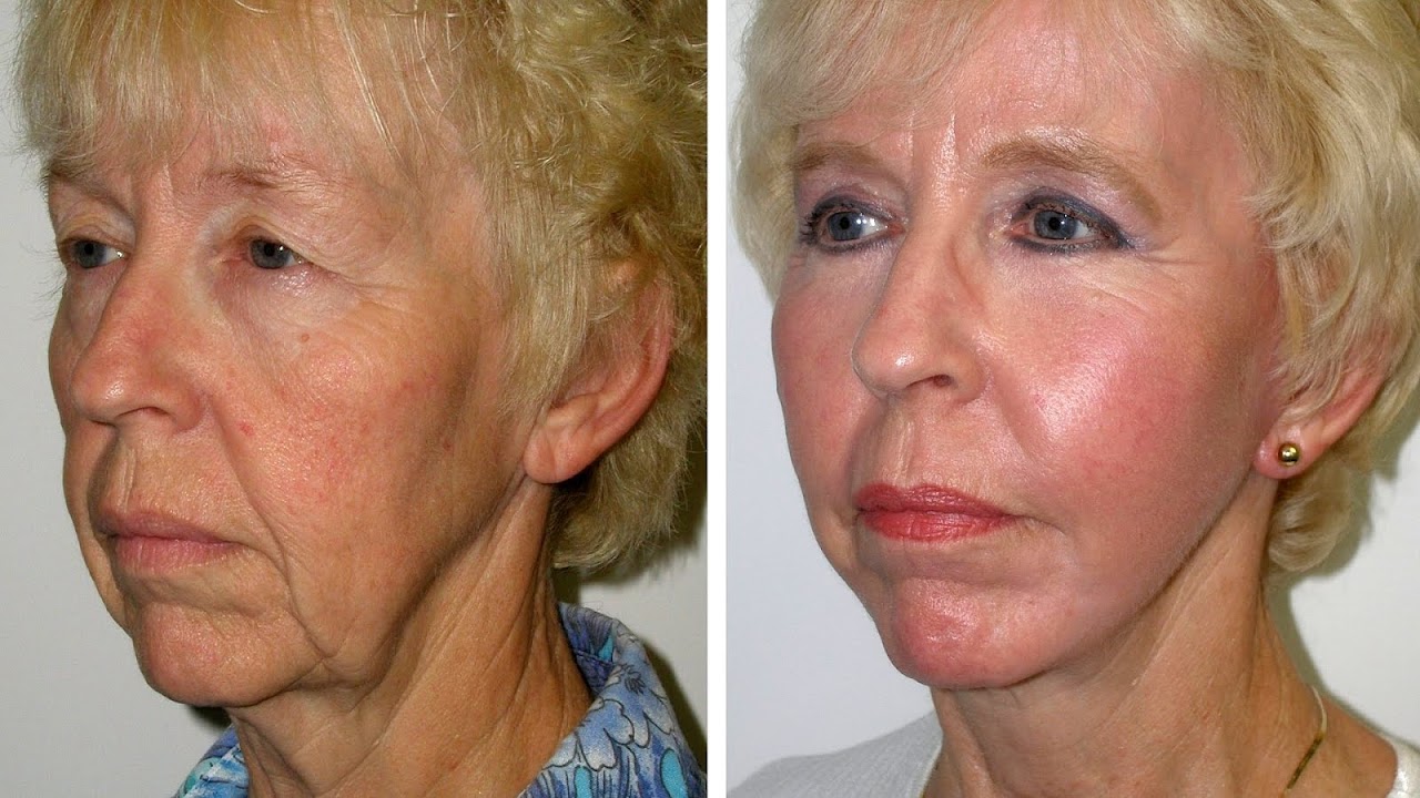 How Much Does Neck Lift Cost Lift Choices