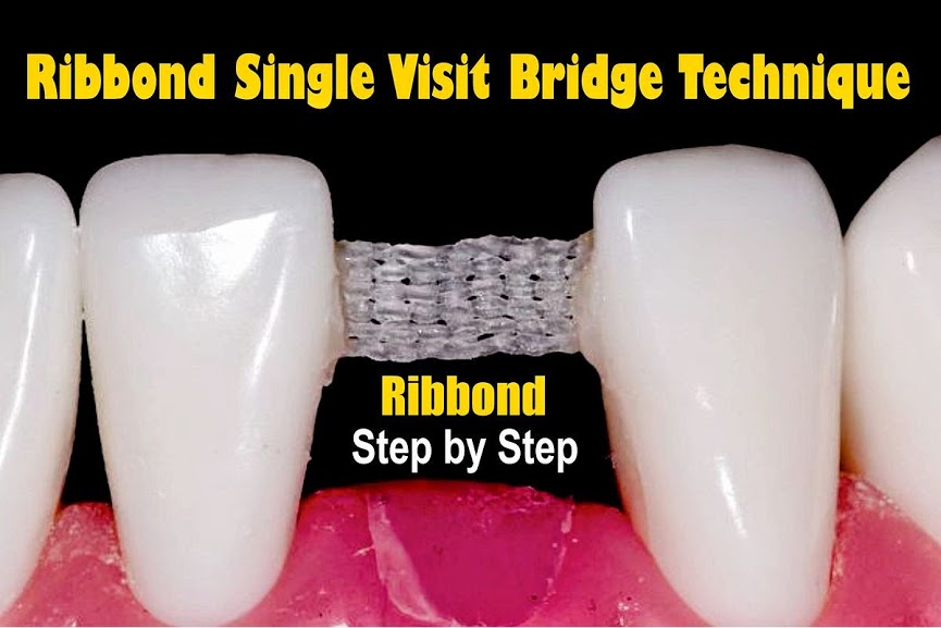 RIBBOND Single Visit Bridge Technique Step by Step