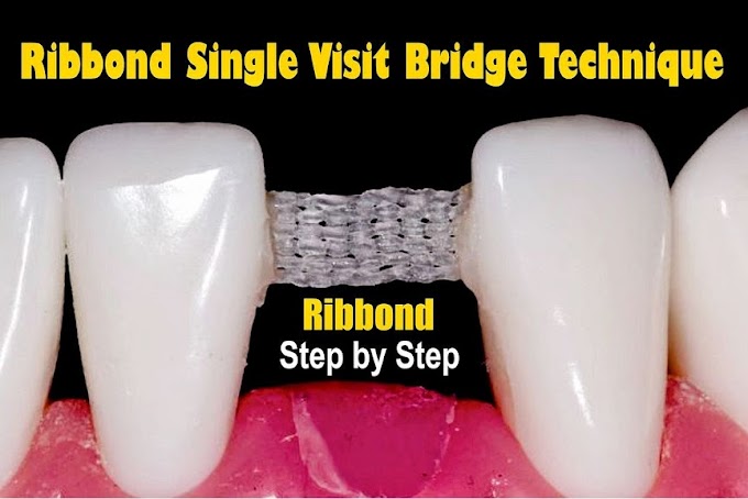 RIBBOND Single Visit Bridge Technique - Step by Step