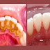 Com este truque simples você irá remover a placa bacteriana sem gastar dinheiro e precisar de ir ao médico