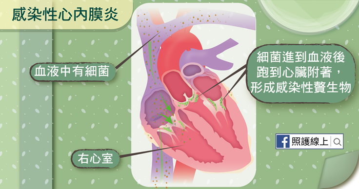 内 感染 性 炎 心 膜
