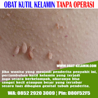 OBAT HERBAL RESEP DOKTER UNTUK MENGOBATI KUTIL KELAMIN