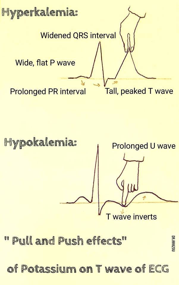 Medicowesome ECG changes seen in hyperkalemia and hypokalemia mnemonic
