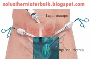 Obat Hernia Terbaik Hingga Sembuh Total Obat Hernia Terbaik Hingga Sembuh Total