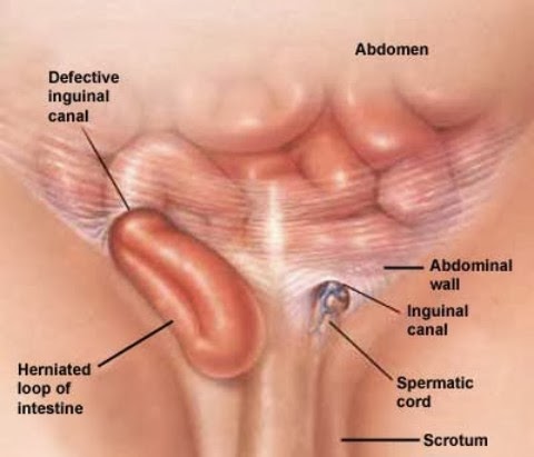 Cara Menyembuhkan Penyakit Hernia Tanpa Operasi