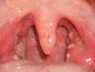 Nguyên nhân gây ra bệnh viêm amidan Nguyên nhân gây ra bệnh viêm amidan