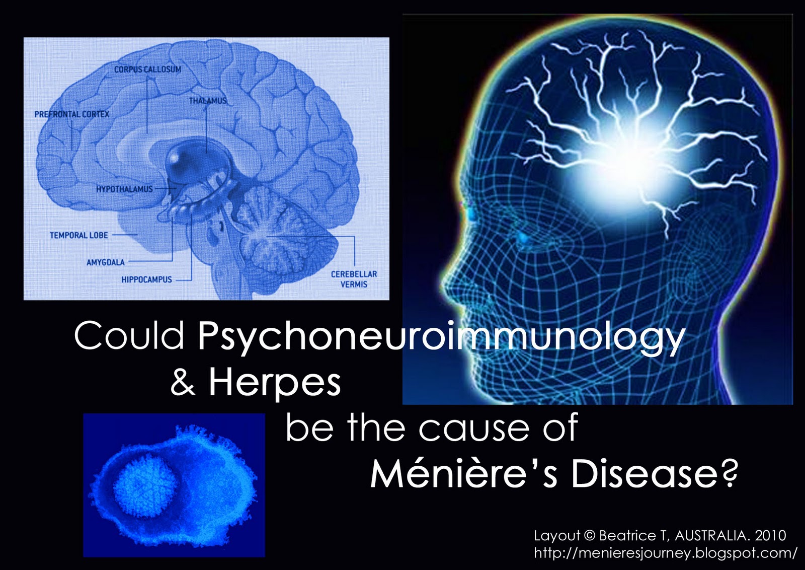 Menieres: An Inner (Ear) Journey: Ménière’s Disease: Is Psychoneuroimmunology (PNI) & Herpes the ...