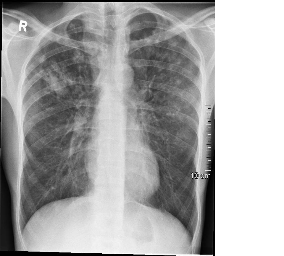 Rheumatologe Infliximab and Tuberculosis, and case presentation