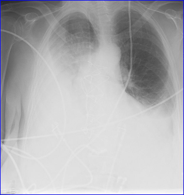 What is the cause of this "white out" on the right side of the chest x