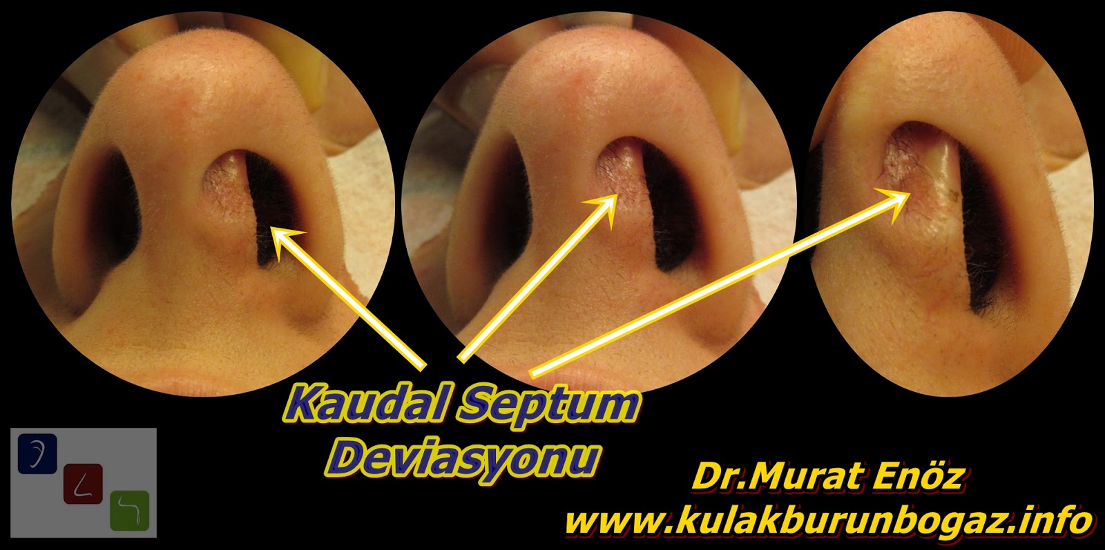 Kaudal septum deviasyonu nedir? - Kaudal septum deviasyonu belirtileri - Kaudal septum deviasyonu tedavisi - Kaudal septum deviasyonu ameliyatı - Kaudal septal deviasyon - Anterior septal deviasyon - Kaudal septoplasti - Açık teknik kaudal septum deviasyonu ameliyatı - Kaudal septum deviasyonu görselleri - Anterior septal dislokasyon - Açık teknik septoplasti ameliyatı - Açık teknik SMR ameliyatı - Açk teknik deviasyon ameliyatı Kaudal septum deviasyonu nedir? - Kaudal septum deviasyonu belirtileri - Kaudal septum deviasyonu tedavisi - Kaudal septum deviasyonu ameliyatı - Kaudal septal deviasyon - Anterior septal deviasyon - Kaudal septoplasti - Açık teknik kaudal septum deviasyonu ameliyatı - Kaudal septum deviasyonu görselleri - Anterior septal dislokasyon - Açık teknik septoplasti ameliyatı - Açık teknik SMR ameliyatı - Açk teknik deviasyon ameliyatı