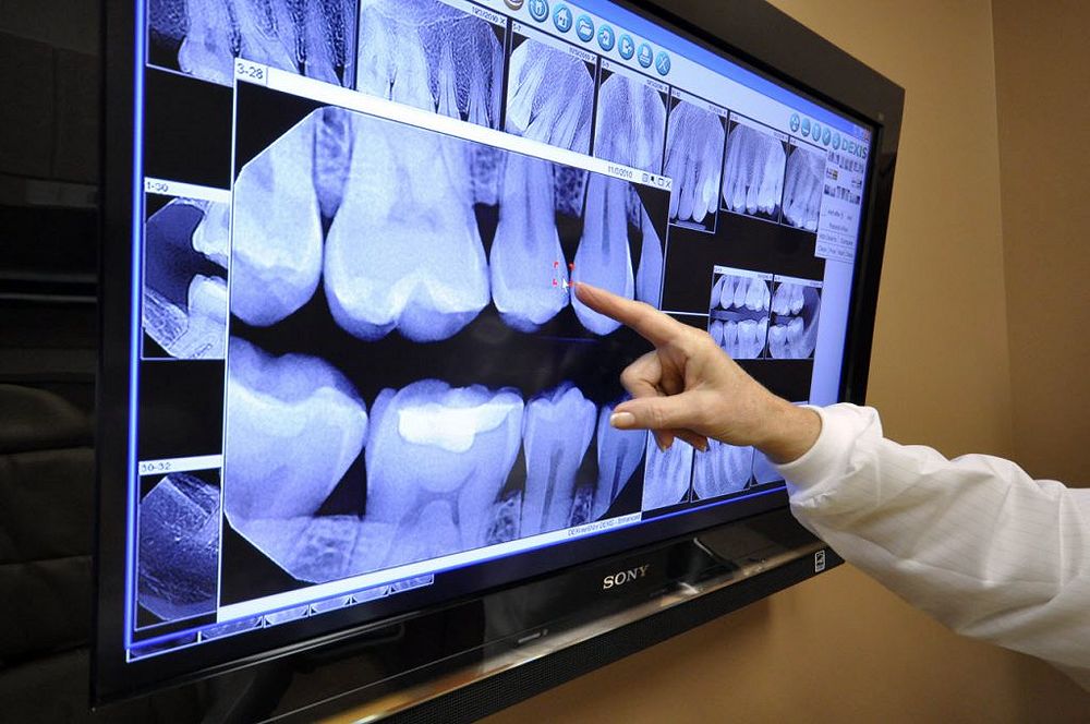 Digital Dental Xrays Described and Explained Directorio Odontológico