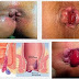 Benjolan pada pinggir anus