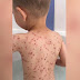 Hay algo que no se debe hacer cuando los niños tienen varicela y que pocos padres saben