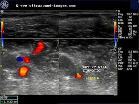 Cochinblogs Doppler Study Severe Stenosis Of The Lower Limb Arteries