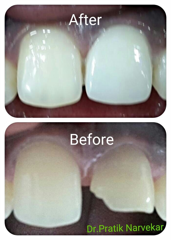 DENTAL TALKS Post Operative Instructions after A Tooth Colored