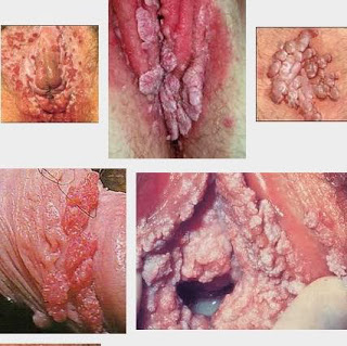 Foto Tips Ampuh Menghilangkan Daging Tumbuh Di Kemaluan Wanita ( Miss V )