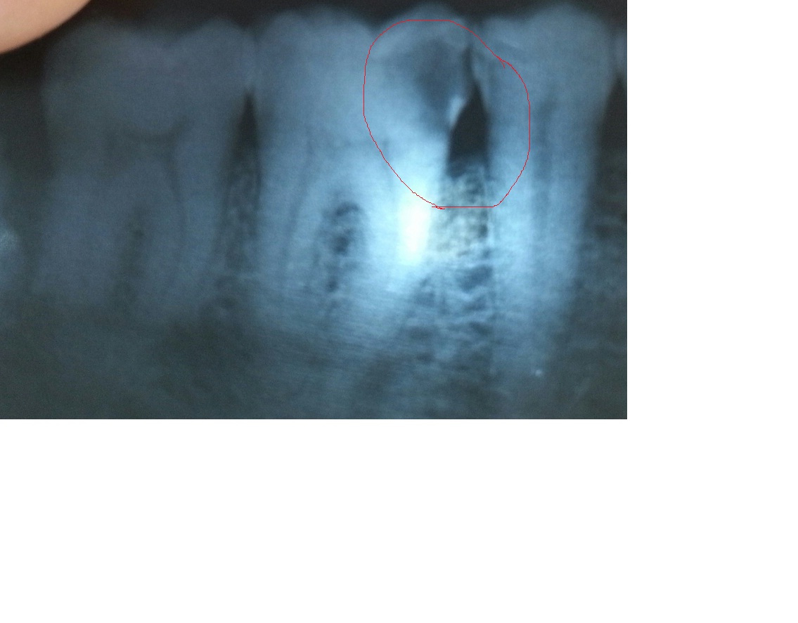 Sale in Kuwait Tanzilaat News تنزيلات Root Canal Treatment in