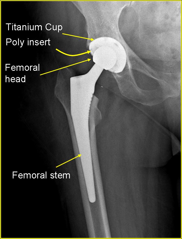 The Bionic Woman My Total Hip Replacement Journey