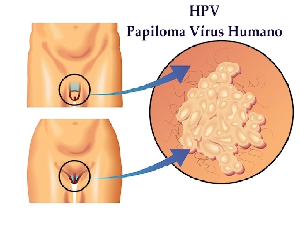 papillomavirus humains hpv)