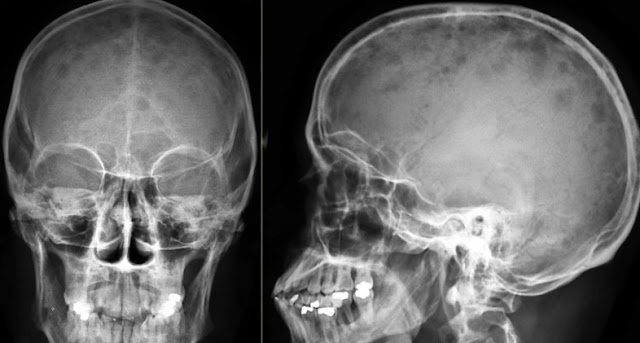 Multiple Myeloma Skull X Ray