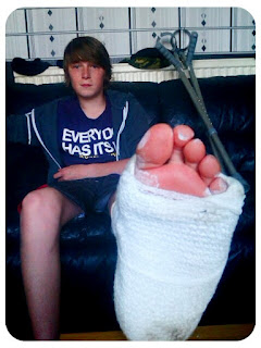 One foot, broken in two places broken foot in plaster
