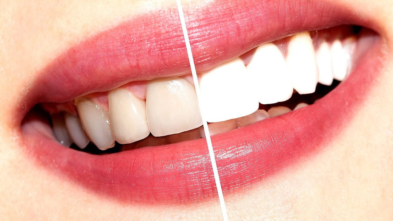 How Much Does Dentist Teeth Whitening Cost White Choices