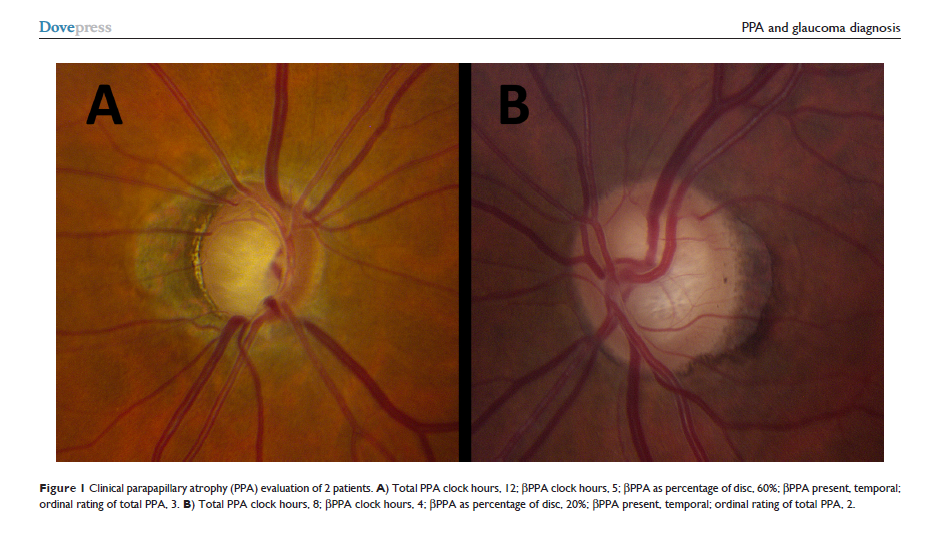 Choroidal Crescent Optic Nerve
