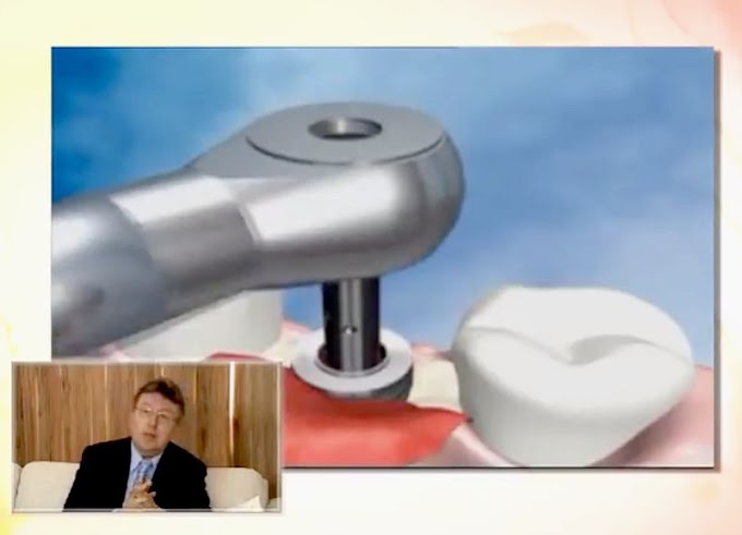 ENTREVISTA: Periodontite e o tratamento de perda óssea para a aplicação de implantes