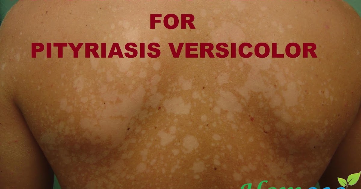 PITYRIASIS VERSICOLOR & HOMOEOPATHY