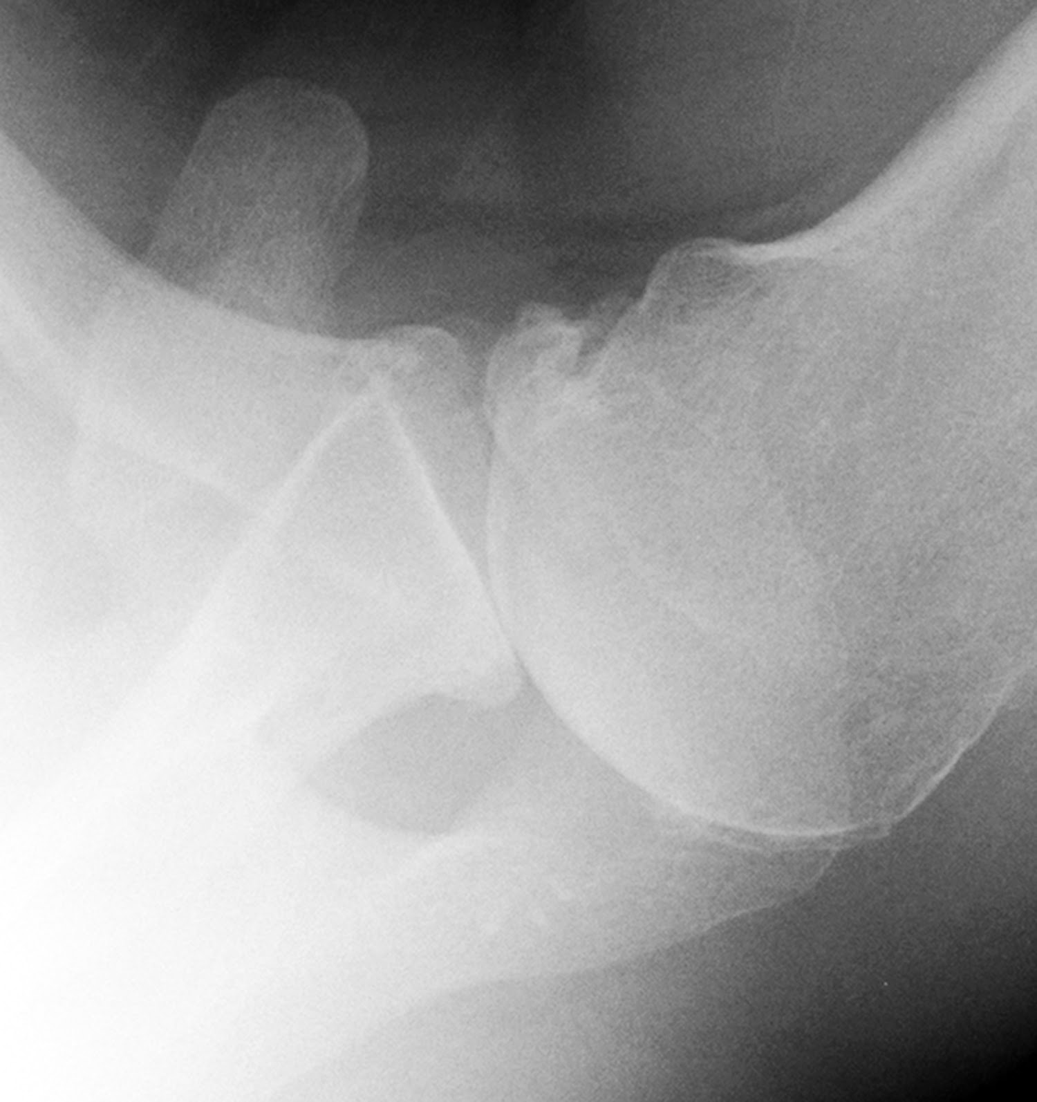 UW Shoulder and Elbow Academy: Is a CT scan needed before a shoulder ...