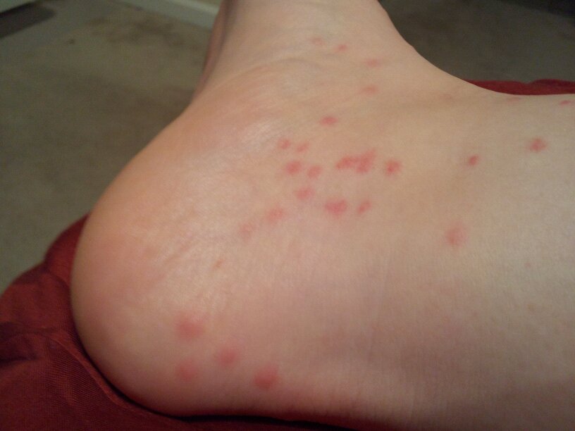 I have red spots on my feet. They just appeared. They have