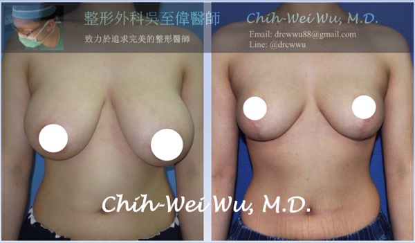 提乳縮小罩杯 提乳縮小罩杯