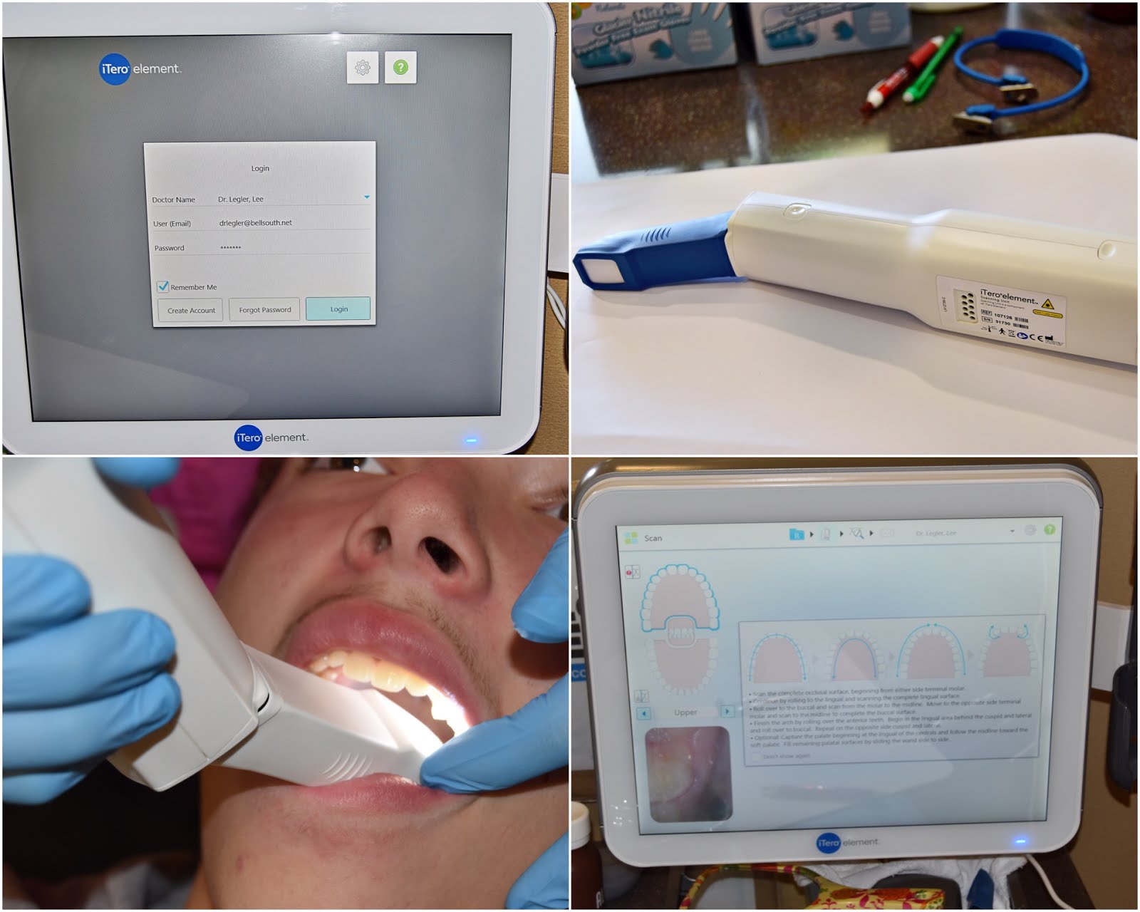 Legler Orthodontics iTero Element Digital Scanner Versus Impressions
