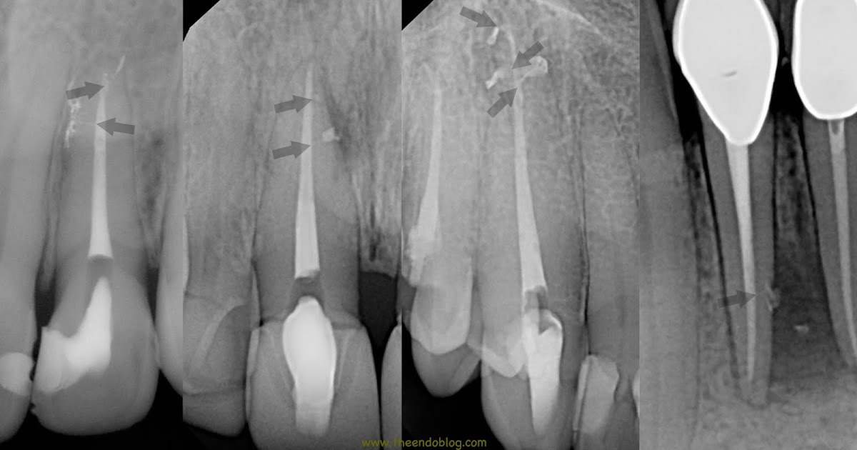 The Endo Blog The Buzz About Endodontic Irrigation