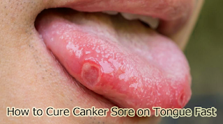 How to Cure Canker Sore on Tongue Fast