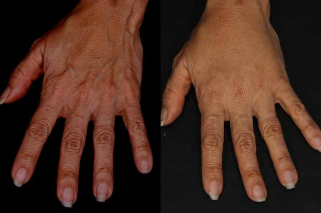 6 amazing hand rejuvenation photos