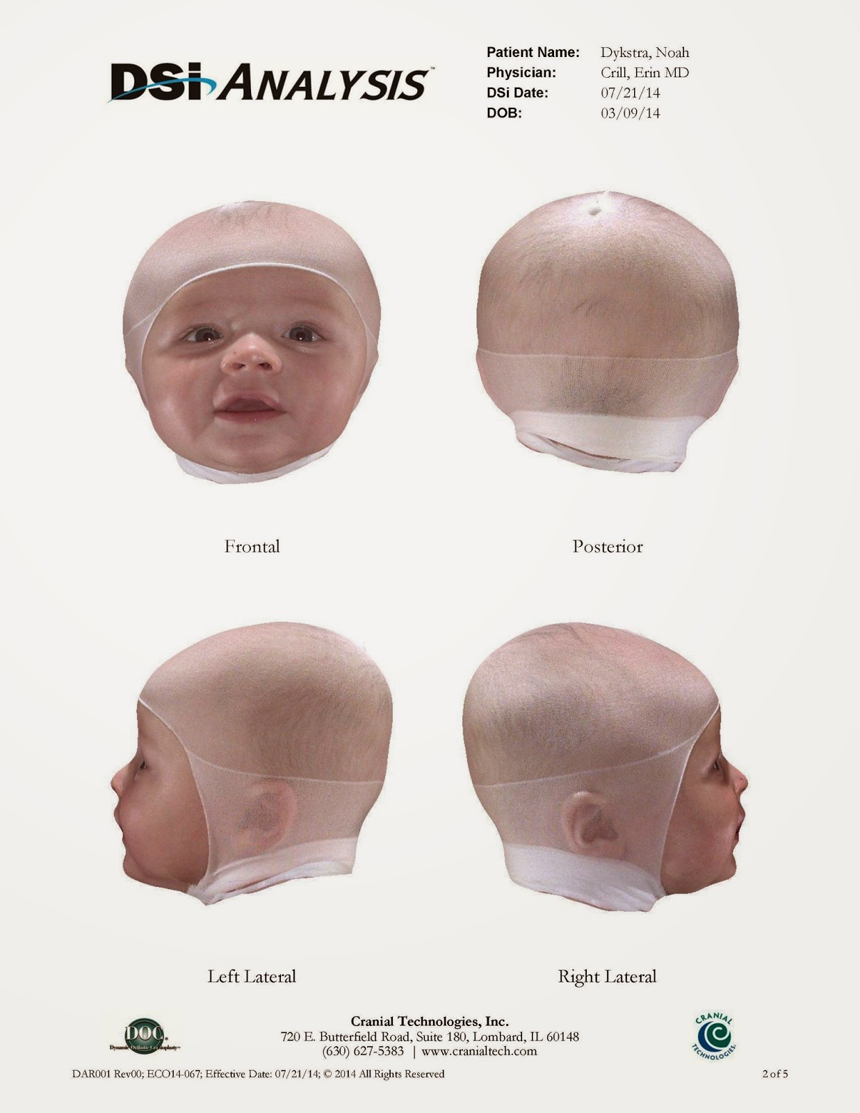 Деформация черепа плагиоцефалия. Плагиоцефалия черепа у детей. Деформационная лобная плагиоцефалия. Позиционная затылочная плагиоцефалия. Плагиоцефалия у ребенка что это.