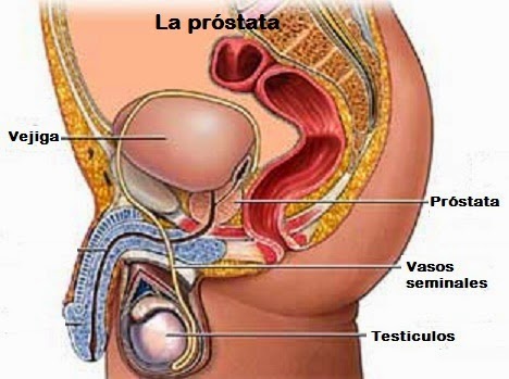 prostata con adenoma mediano)