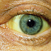 Jaundice